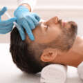 Hair Transplants: Weighing the Upsides and Downsides!